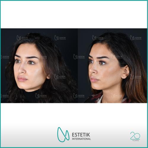 fotos antes y después de nuestros pacientes - Genioplastia - Dr. Çağatay Güngörsün